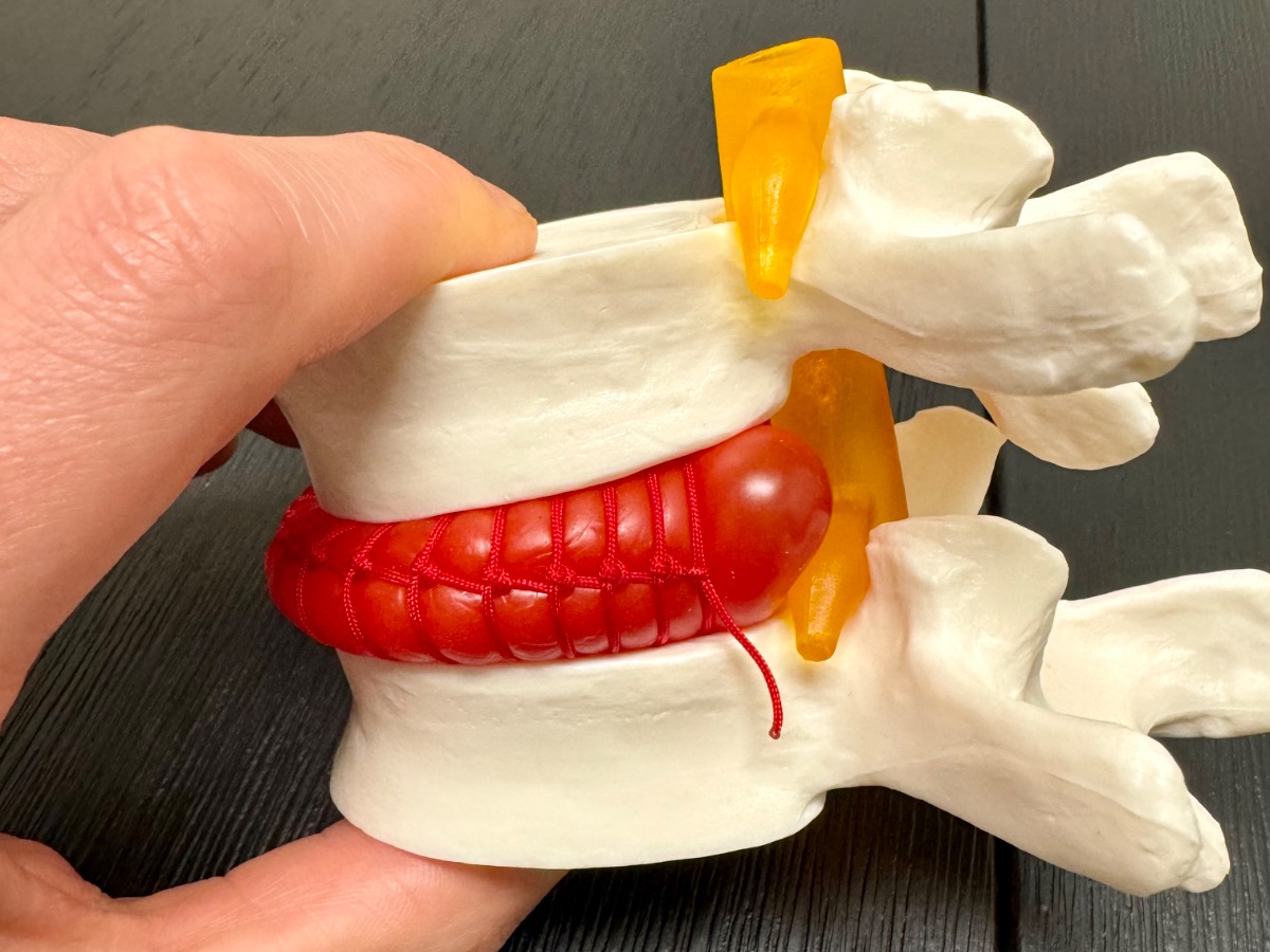 A spine model showing a bulging disc